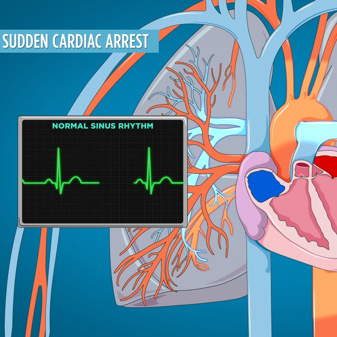 CPR Sudden Cardiac Arrest