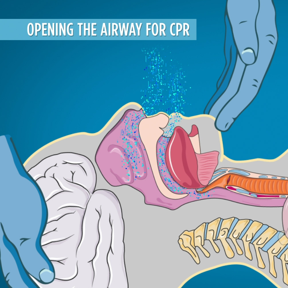 Opening the Airway for CPR